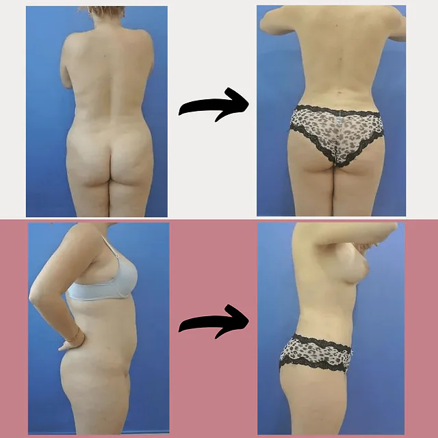 Caso fotográfico de Lipoescultura, imagen comparativa 8