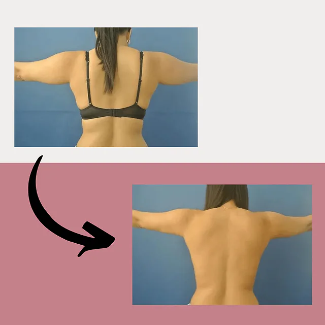 Caso fotográfico de Lipoescultura, imagen comparativa 7