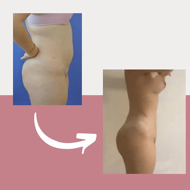 Caso fotográfico de Lipoescultura, imagen comparativa 6