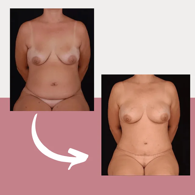 Caso fotográfico de Abdominoplastia, imagen comparativa 41