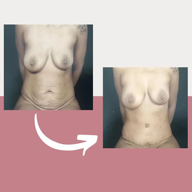 Caso fotográfico de Abdominoplastia, imagen comparativa 42