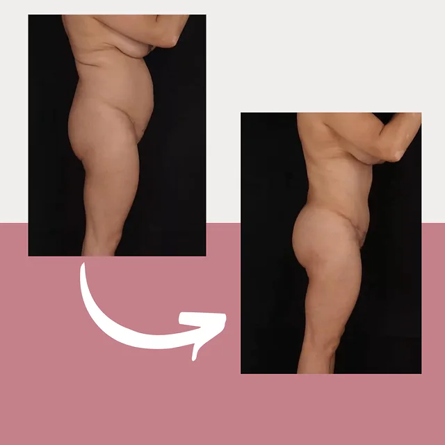 Caso fotográfico de Abdominoplastia, imagen comparativa 43