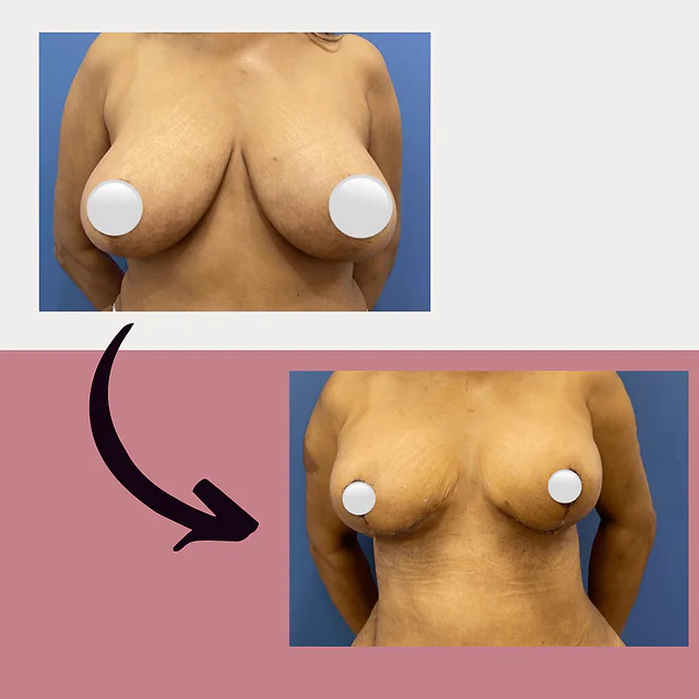 Caso fotográfico de Reducción Mamaria, imagen comparativa 2