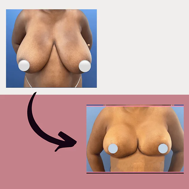 Caso fotográfico de Reducción Mamaria, imagen comparativa 3