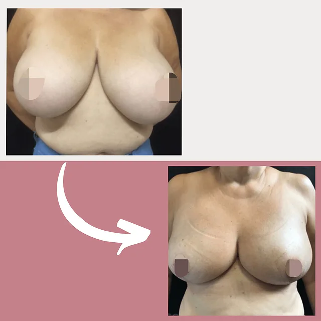 Caso fotográfico de Reducción Mamaria, imagen comparativa 4