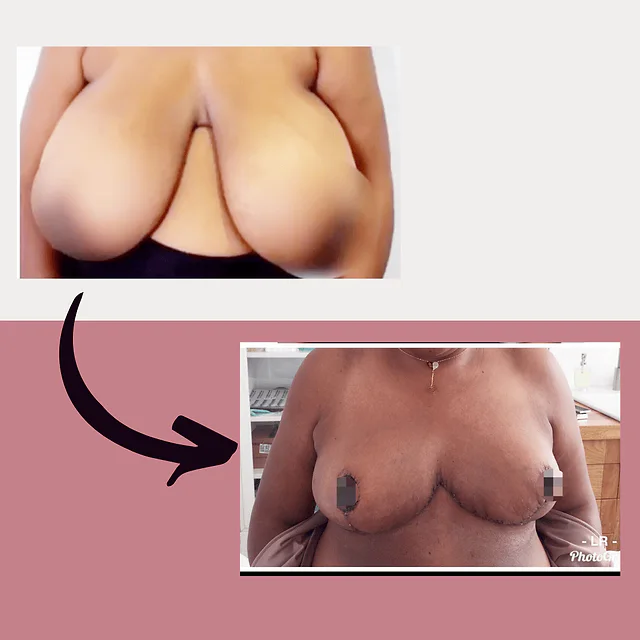 Caso fotográfico de Reducción Mamaria, imagen comparativa 5