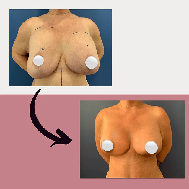 Caso fotográfico de Reducción Mamaria, imagen comparativa 6