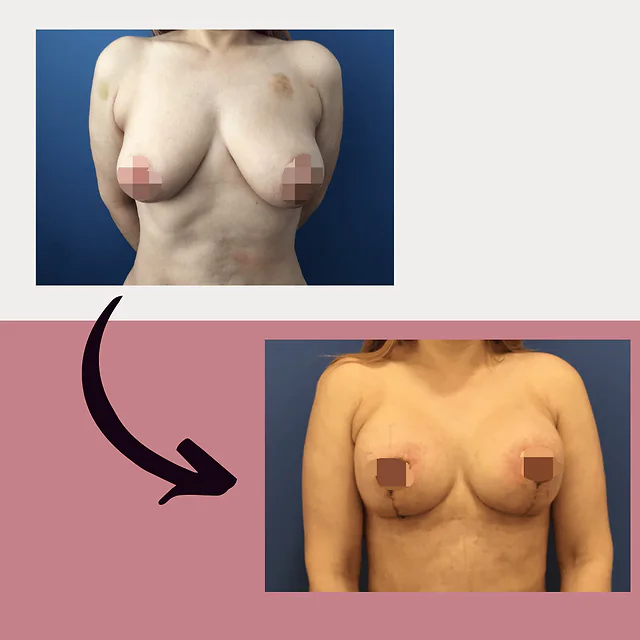 Caso fotográfico de Levantamiento Mamario, imagen comparativa 12