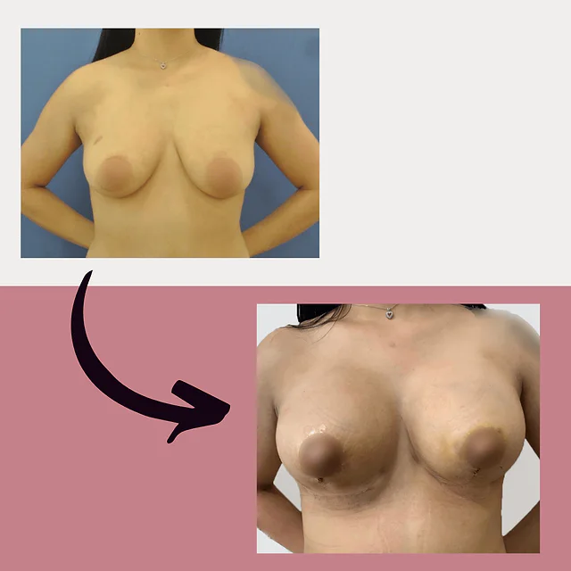 Caso fotográfico de Levantamiento Mamario, imagen comparativa 14