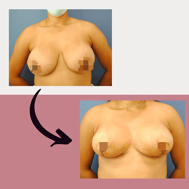 Caso fotográfico de Levantamiento Mamario, imagen comparativa 15