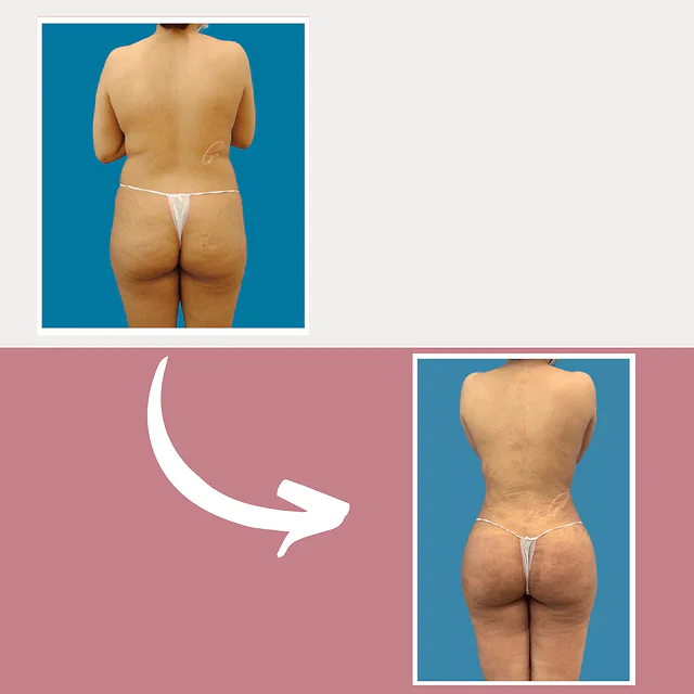 Caso fotográfico de Levantamiento de Glúteos Brasileño, imagen comparativa 8
