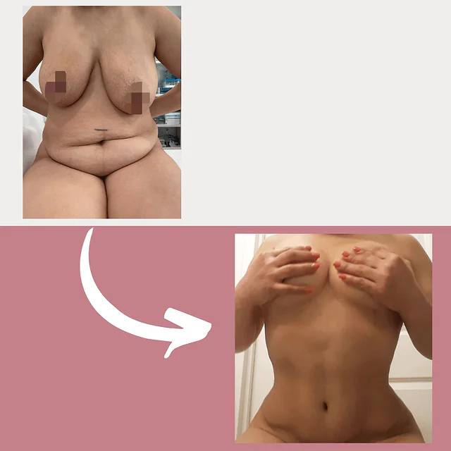 Caso fotográfico de Abdominoplastia, imagen comparativa 40