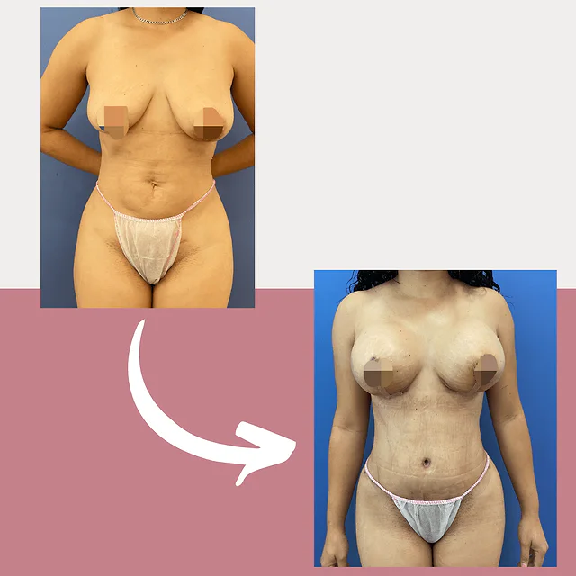 Caso fotográfico de Levantamiento Mamario, imagen comparativa 11