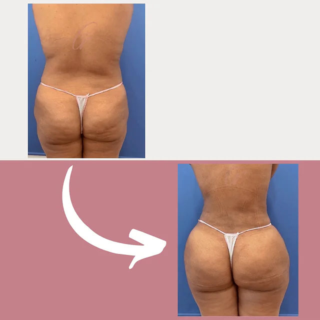 Caso fotográfico de Levantamiento de Glúteos Brasileño, imagen comparativa 7