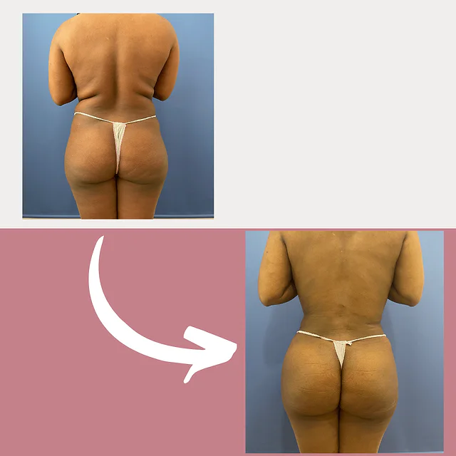Caso fotográfico de Levantamiento de Glúteos Brasileño, imagen comparativa 5