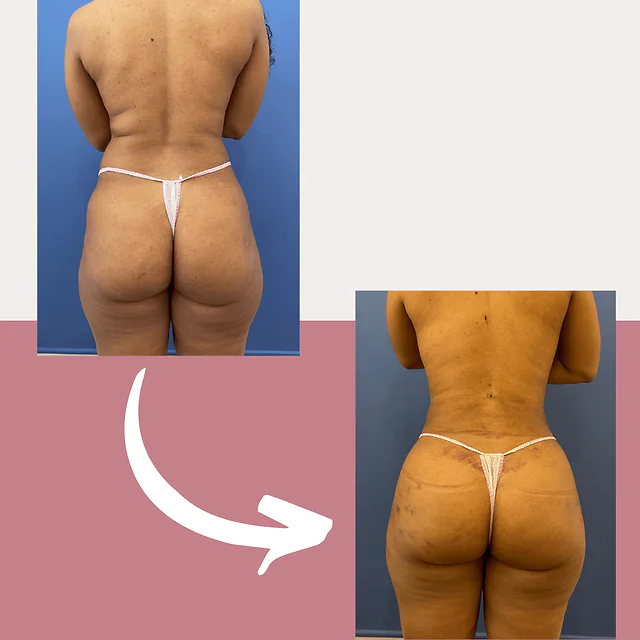 Caso fotográfico de Levantamiento de Glúteos Brasileño, imagen comparativa 6