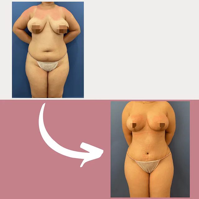 Caso fotográfico de Abdominoplastia, imagen comparativa 39