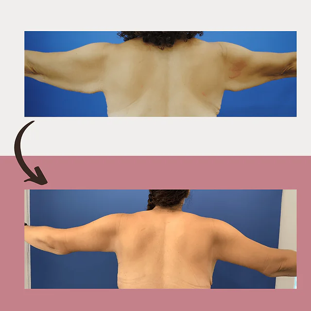 Caso fotográfico de Levantamiento de Brazos, imagen comparativa 3