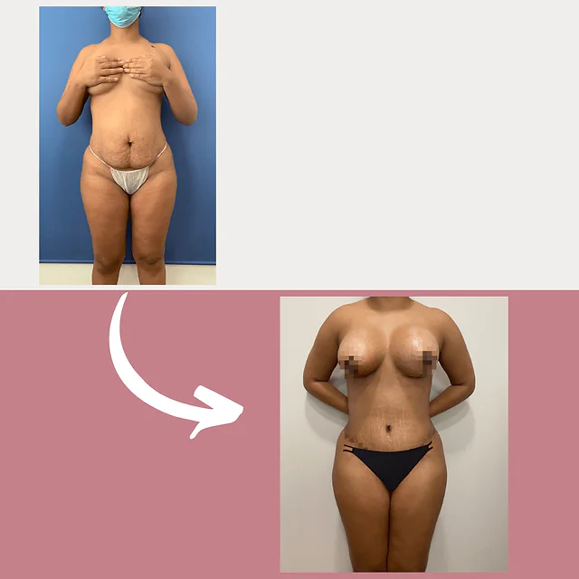 Caso fotográfico de Abdominoplastia, imagen comparativa 36