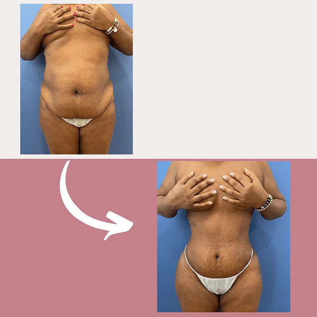 Caso fotográfico de Abdominoplastia, imagen comparativa 37