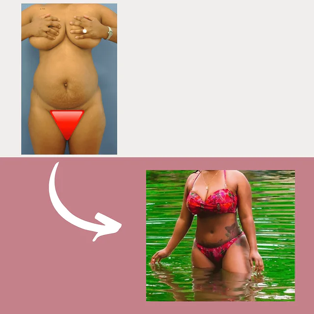 Caso fotográfico de Abdominoplastia, imagen comparativa 38