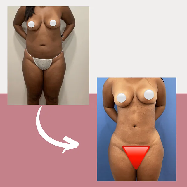 Caso fotográfico de Lipoescultura, imagen comparativa 3