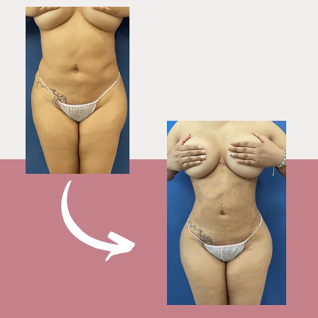 Caso fotográfico de Lipoescultura, imagen comparativa 4