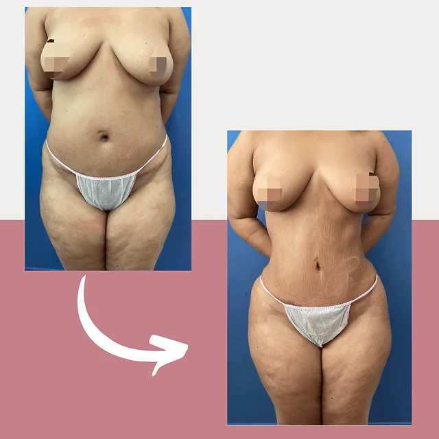 Caso fotográfico de Lipoescultura, imagen comparativa 5