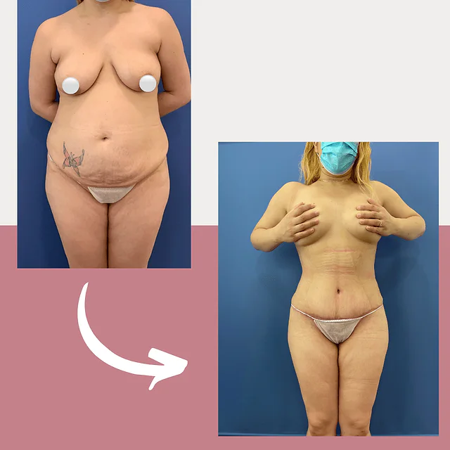 Caso fotográfico de Abdominoplastia, imagen comparativa 29