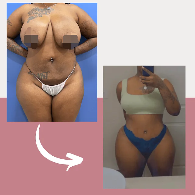 Caso fotográfico de Abdominoplastia, imagen comparativa 30