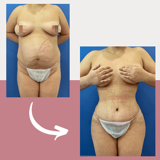 Caso fotográfico de Abdominoplastia, imagen comparativa 31
