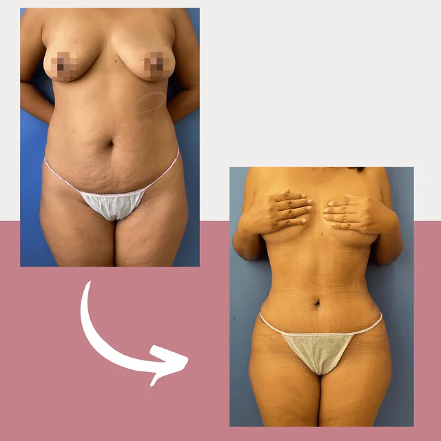 Caso fotográfico de Abdominoplastia, imagen comparativa 32