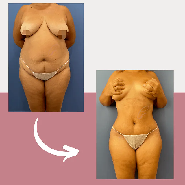 Caso fotográfico de Abdominoplastia, imagen comparativa 33