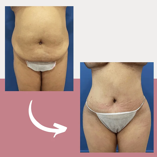 Caso fotográfico de Abdominoplastia, imagen comparativa 34
