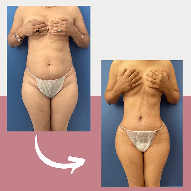 Caso fotográfico de Abdominoplastia, imagen comparativa 35