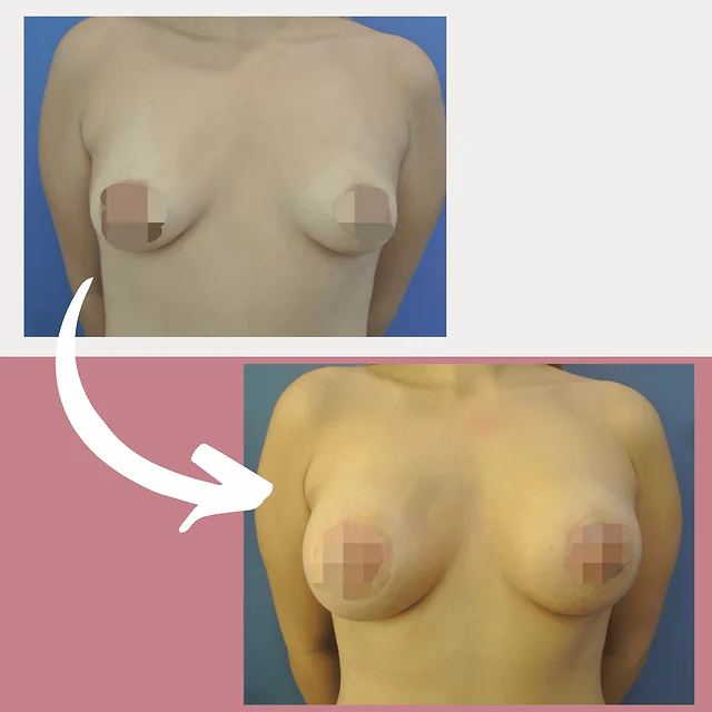 Caso fotográfico de Aumento Mamario, imagen comparativa 2