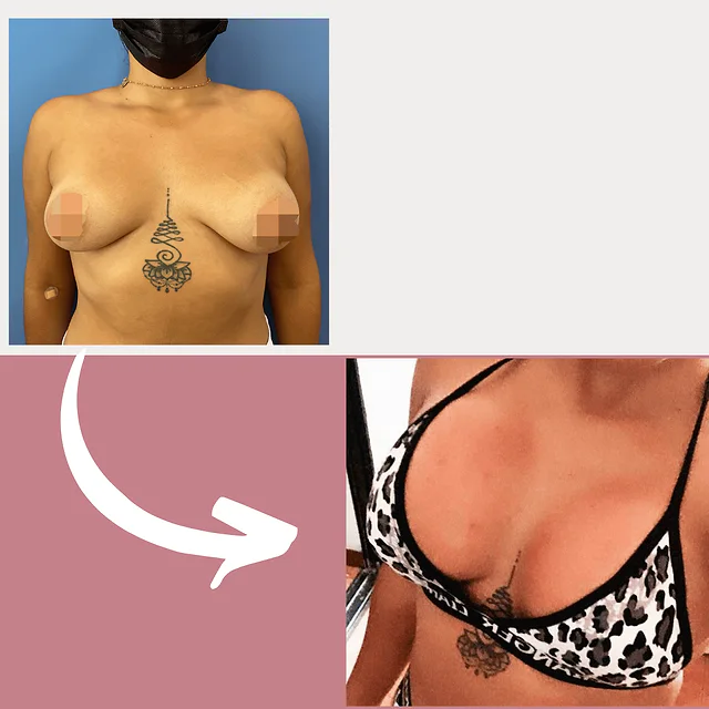 Caso fotográfico de Aumento Mamario, imagen comparativa 3