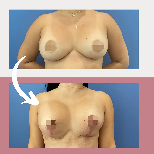 Caso fotográfico de Aumento Mamario, imagen comparativa 6