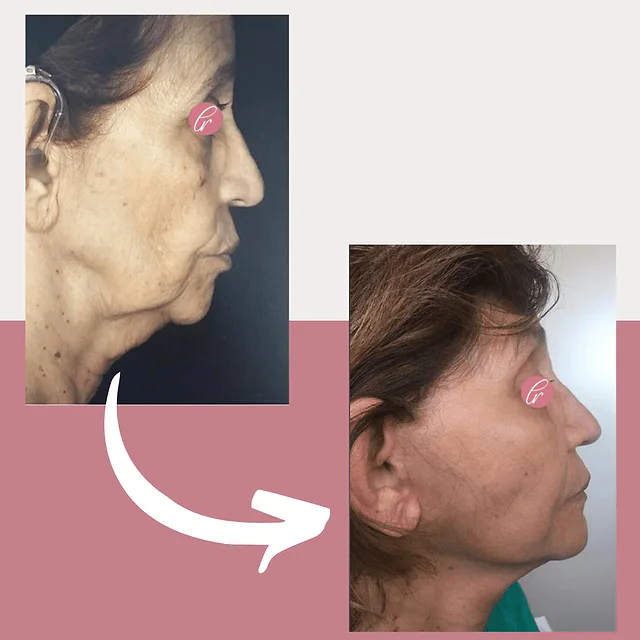 Caso fotográfico de Lifting Facial, imagen comparativa 4