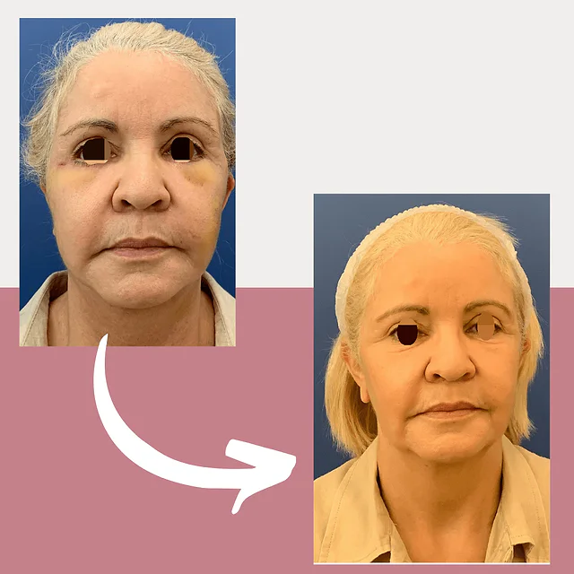 Caso fotográfico de Lifting Facial, imagen comparativa 5