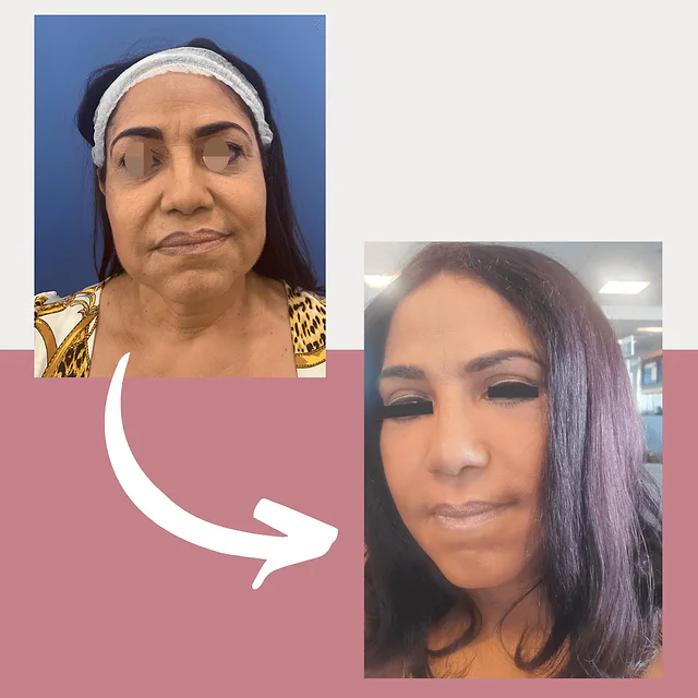 Caso fotográfico de Lifting Facial, imagen comparativa 6