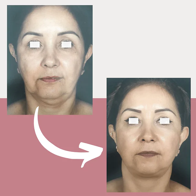 Caso fotográfico de Lifting Facial, imagen comparativa 8