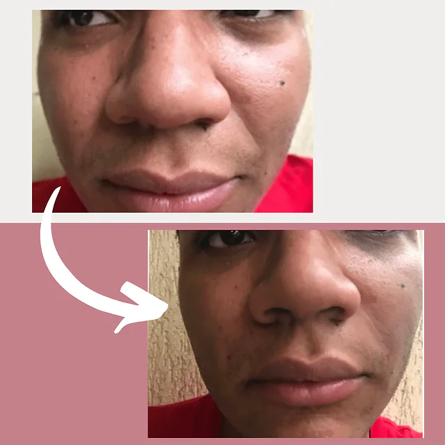 Caso fotográfico de Rellenos Faciales, imagen comparativa 4