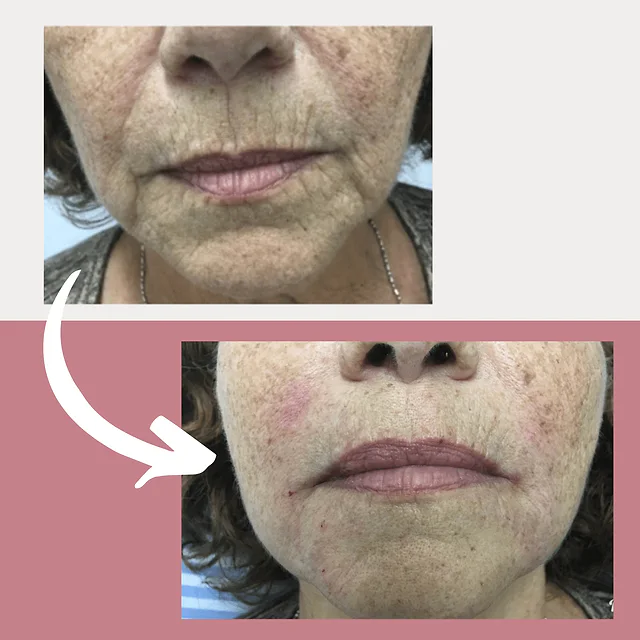 Caso fotográfico de Rellenos Faciales, imagen comparativa 5