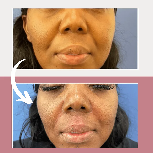 Caso fotográfico de Rellenos Faciales, imagen comparativa 6