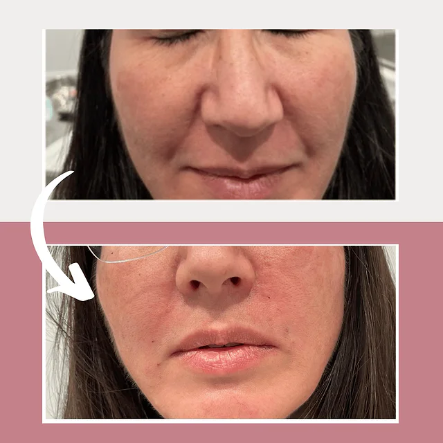 Caso fotográfico de Rellenos Faciales, imagen comparativa 7
