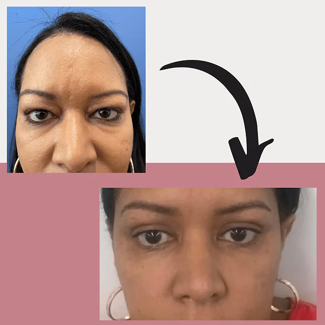 Caso fotográfico de Blefaroplastia, imagen comparativa 6