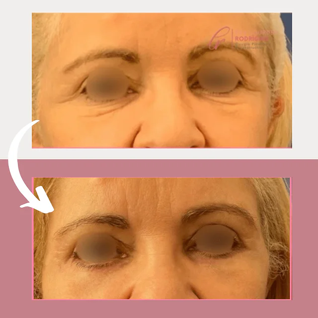 Caso fotográfico de Blefaroplastia, imagen comparativa 7