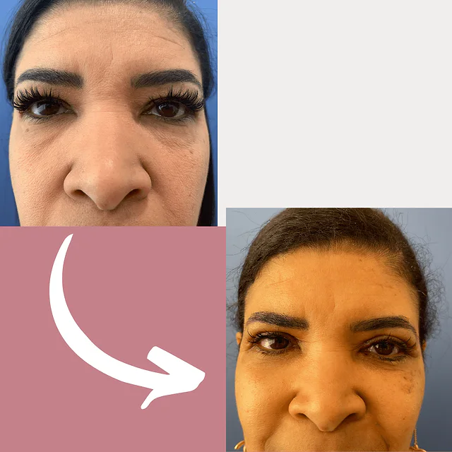 Caso fotográfico de Blefaroplastia, imagen comparativa 8
