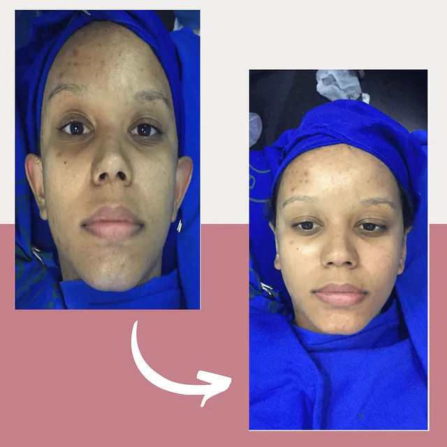 Caso fotográfico de Otoplastia, imagen comparativa 1